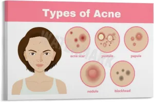 INSTR Beauty Salon Poster Acne Type Guide Art Wall Poster Wall Poster Art Canvas Printing Poster Office Bedroom Aesthetic Poster Frame-style 24x16inch(60x40cm)