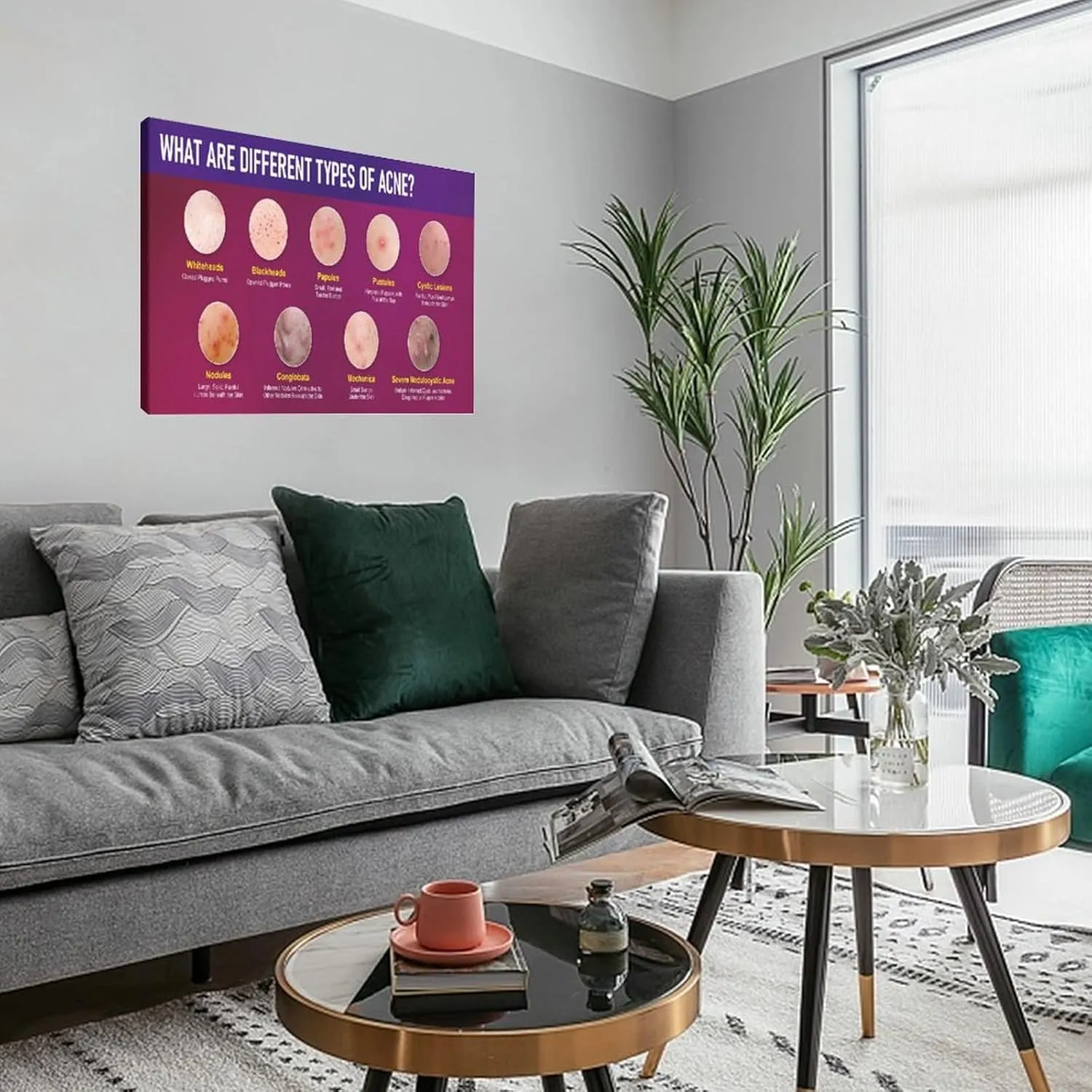 Types of Acne Poster Medical Beauty Poster (2) Wall Poster Art Canvas Printing Living Room Office Bedroom Aesthetic Poster 30x20inch(75x50cm) Frame-style