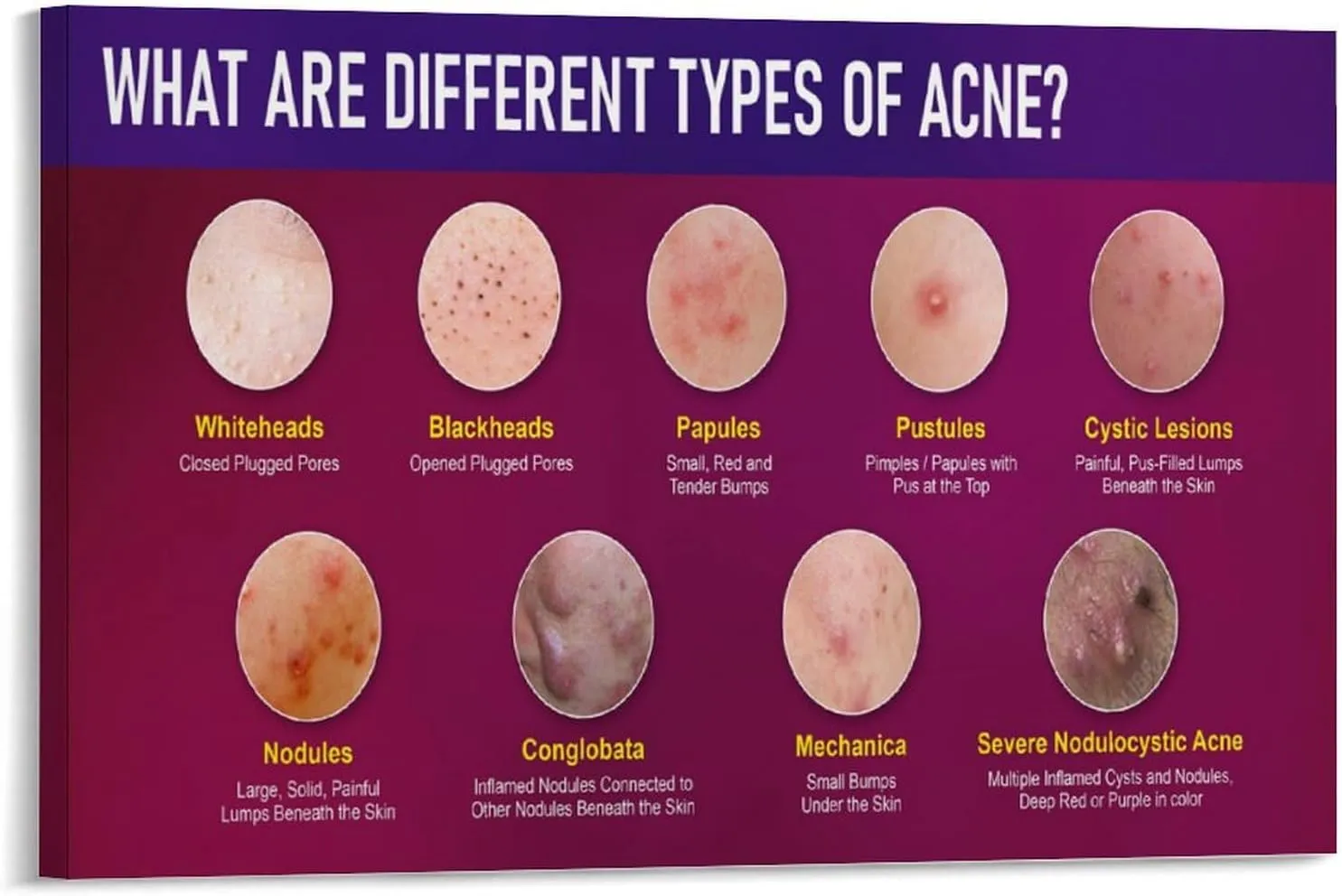 Types of Acne Poster Medical Beauty Poster (2) Wall Poster Art Canvas Printing Living Room Office Bedroom Aesthetic Poster 30x20inch(75x50cm) Frame-style