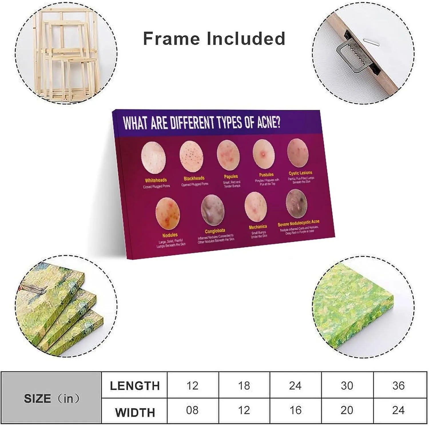 Types of Acne Poster Medical Beauty Poster (2) Wall Poster Art Canvas Printing Living Room Office Bedroom Aesthetic Poster 30x20inch(75x50cm) Frame-style
