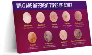 Types of Acne Poster Medical Beauty Poster (2) Wall Poster Art Canvas Printing Living Room Office Bedroom Aesthetic Poster 30x20inch(75x50cm) Frame-style
