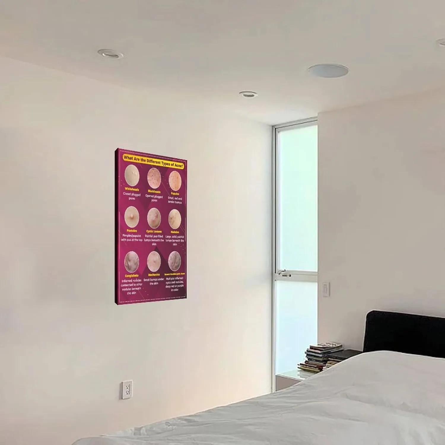 Types of Acne Poster Medical Beauty Poster (3) Wall Poster Art Canvas Printing Living Room Office Bedroom Aesthetic Poster 24x36inch(60x90cm) Frame-style