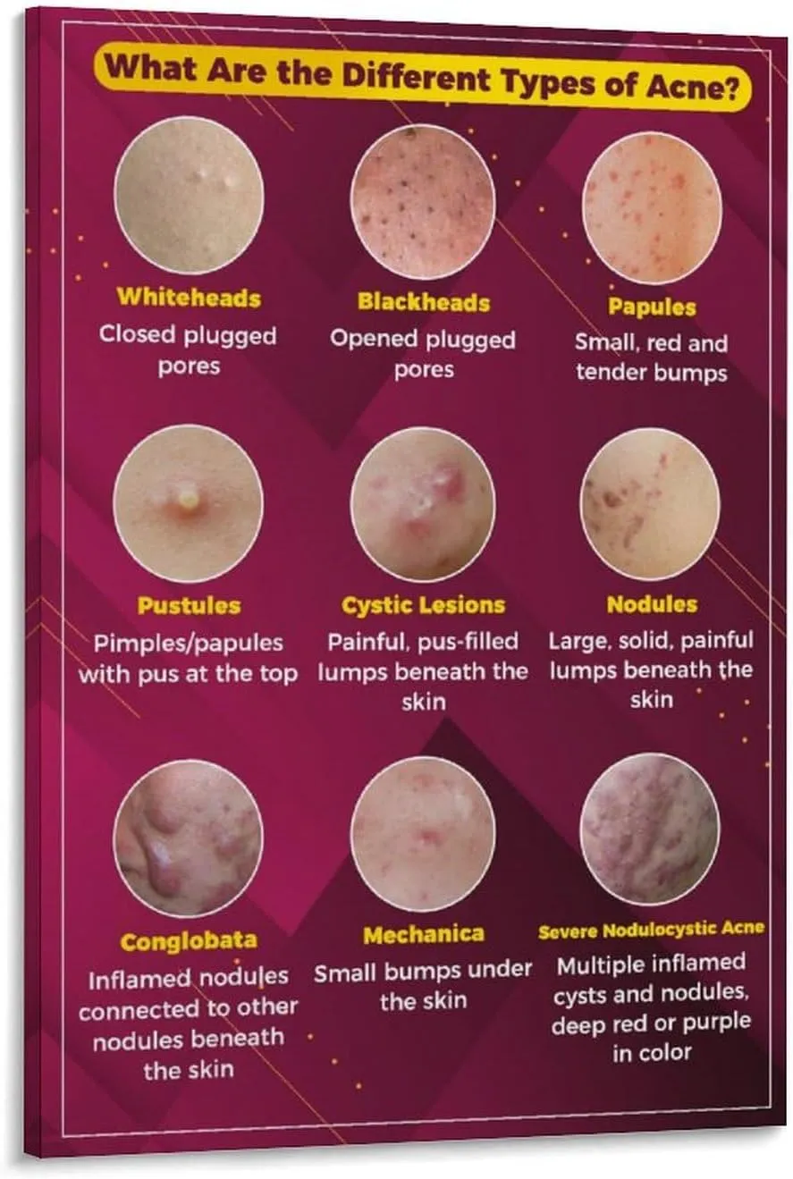 Types of Acne Poster Medical Beauty Poster (3) Wall Poster Art Canvas Printing Living Room Office Bedroom Aesthetic Poster 24x36inch(60x90cm) Frame-style