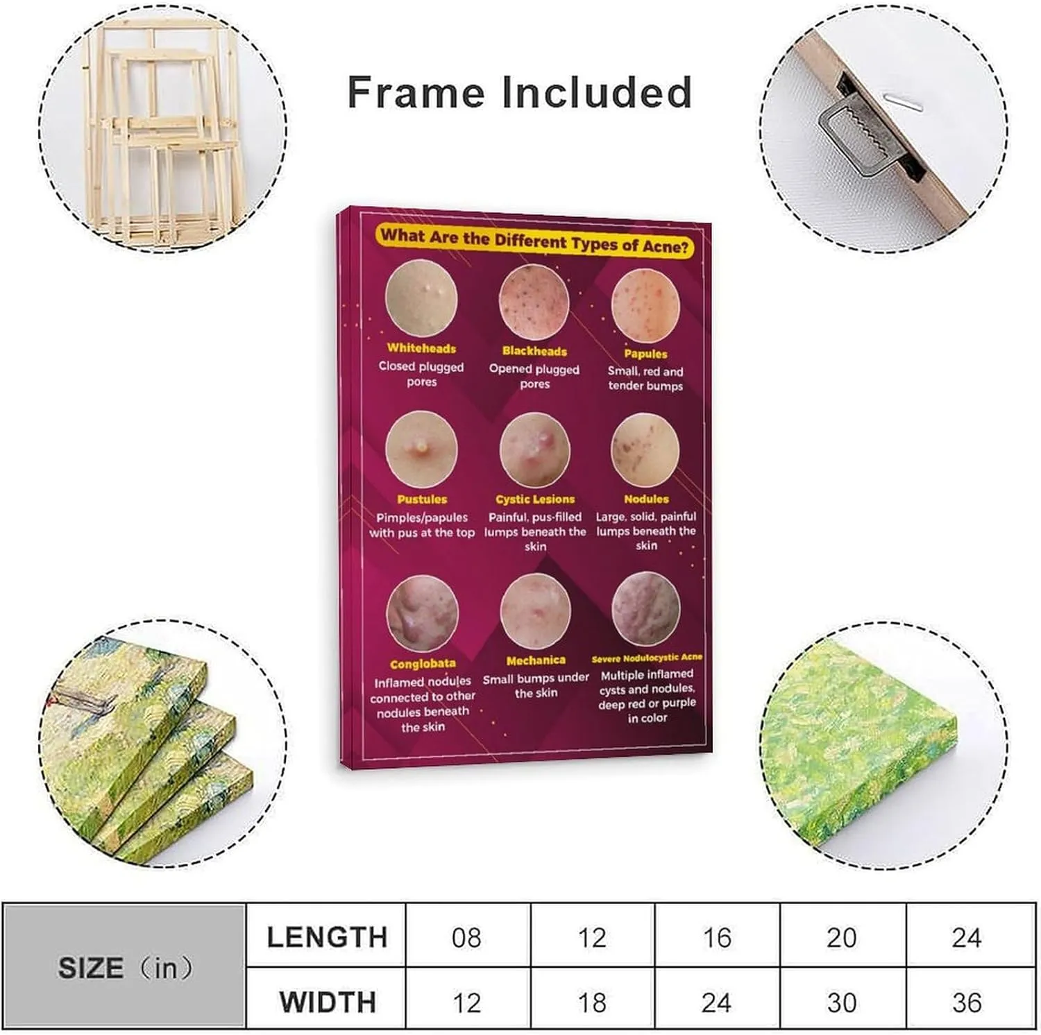 Types of Acne Poster Medical Beauty Poster (3) Wall Poster Art Canvas Printing Living Room Office Bedroom Aesthetic Poster 24x36inch(60x90cm) Frame-style