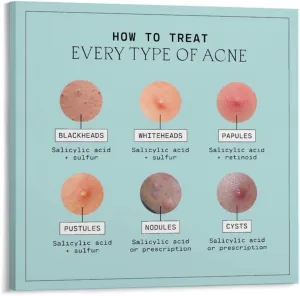Types of Acne Poster Medical Beauty Poster (6) Wall Poster Art Canvas Printing Living Room Office Bedroom Aesthetic Poster 20x20inch(50x50cm) Frame-style
